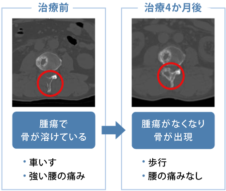 転移性骨腫瘍 （骨転移）