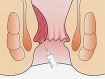 肛門疾患治療